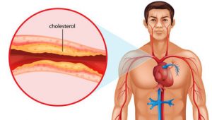 cholesterol heart disease clog arteries