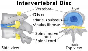 disc herniation intervertebral 