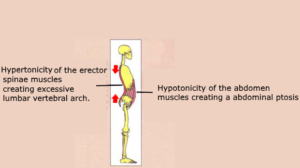Hypertonicity erector spinae muscles lumbar vertebral arch Hypotonicity abdominal ptosis