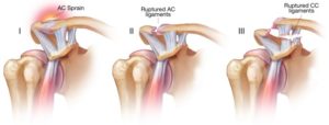 acromioclavicular joint injury type grade