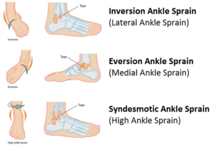ankle sprain inversion eversion syndesmatic lateral medial high