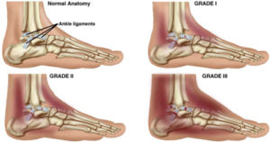 ankle sprain stretch injury grade