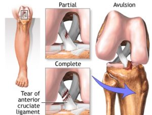 anterior cruciate ligament injury tear