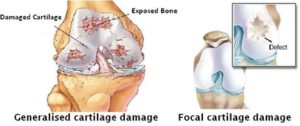 articular cartilage injury
