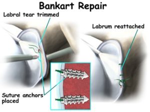 shoulder dislocation treatment surgery bankart repair