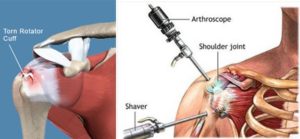 rotator cuff tear anatomy surgery