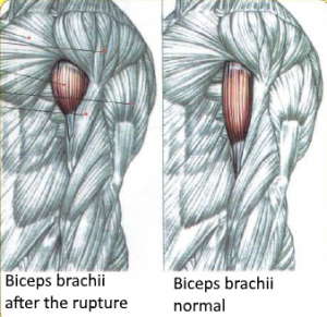 biceps brachiitTendon rupture