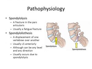 spondyloystesis