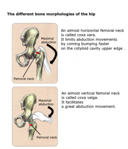 hip mobility abduction coxa vara valga bone morphology
