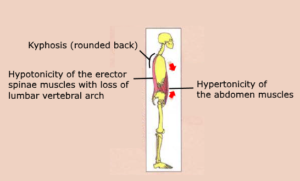 Kyphosis Hypotonicity erector spinae muscles lumbar vertebral arch Hypertonicity abdomen
