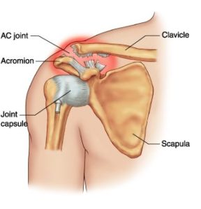 acromioclavicular joint injury