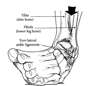 ankle sprain inversion lateral