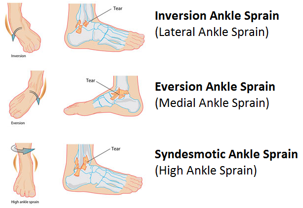 Medial Ankle Sprain
