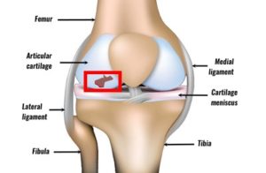 articular cartilage injury