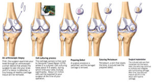 articular cartilage injury treatment