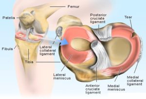 meniscus tear