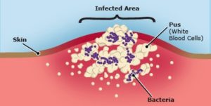 mrsa infection anatomy