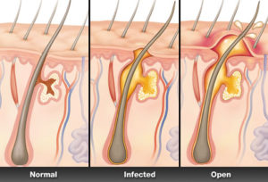 mrsa infection anatomy
