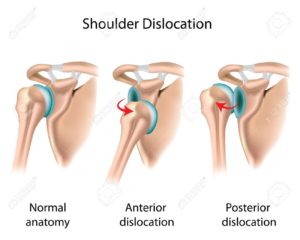 shoulder dislocation anatomy