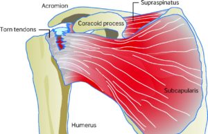 rotator cuff tear anatomy