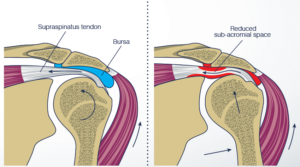 shoulder impingement