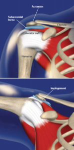 shoulder impingement