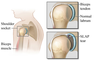 slap tear anatomy shoulder