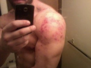 sport injury steroids performance enhancing drug side effect acne