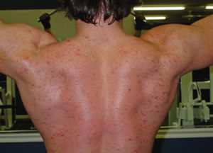 sport injury steroids performance enhancing drug side effect acne
