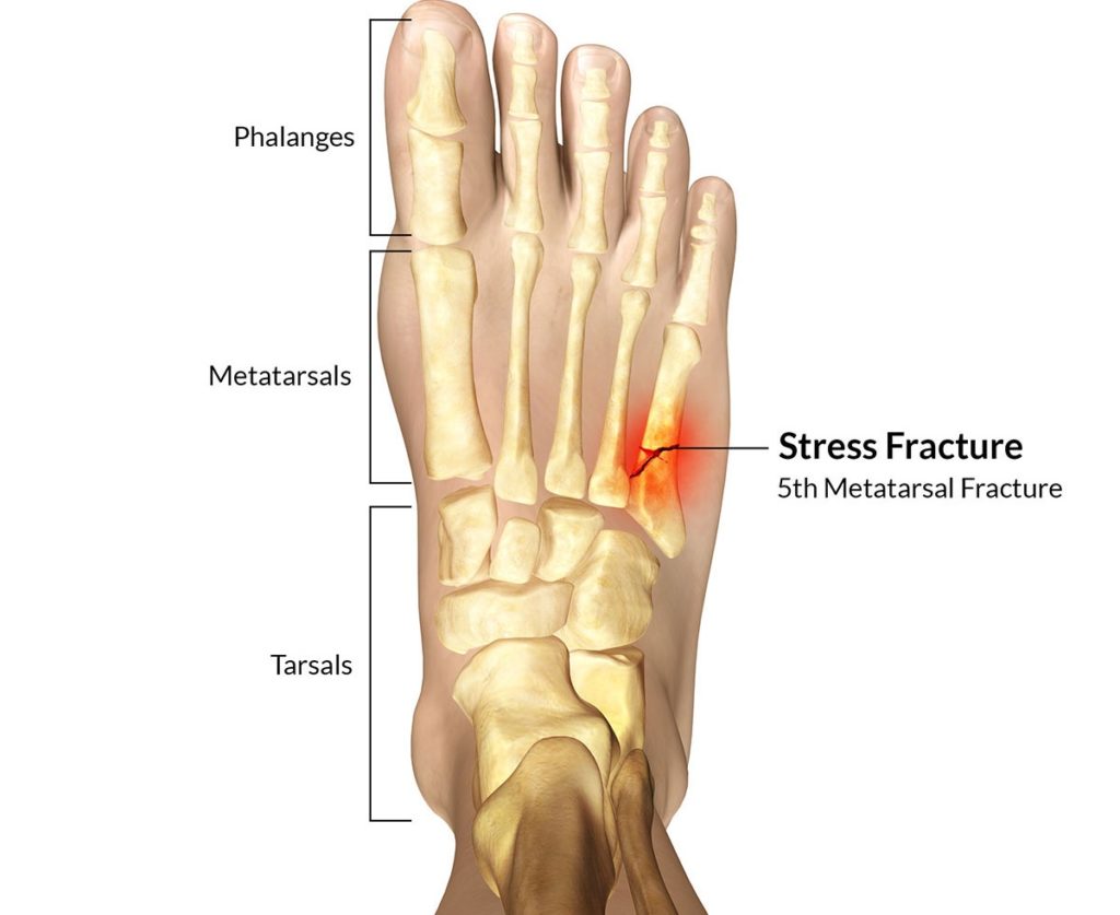 Stress Fractures Stephane Andre